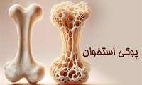 فعالیت بدنی منظم راهکار پیشگیری از پوکی استخوان/ زنان شهرستان بهار غربالگری شدند